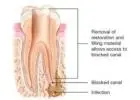 Expert Root Canal Procedure Dupont Circle: Capitol Endodontics