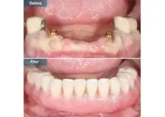 Best Dental Implant in Boon Keng