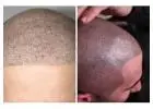 Best treatment for Scalp Micro Pigmentation in Fairview