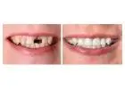 Best Dental Implant in Orchard